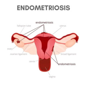 Endometriosis - The Endometriosis Experts