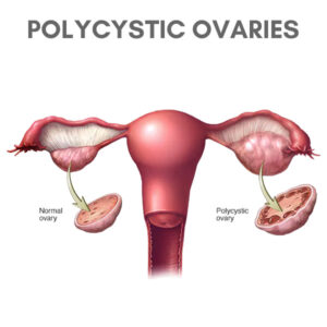 Polycystic Ovaries - The Polycystic Ovaries Experts - The Experts Program